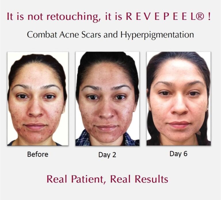 RevePeel | Essent Spa & Medical Spa | Philadelphia